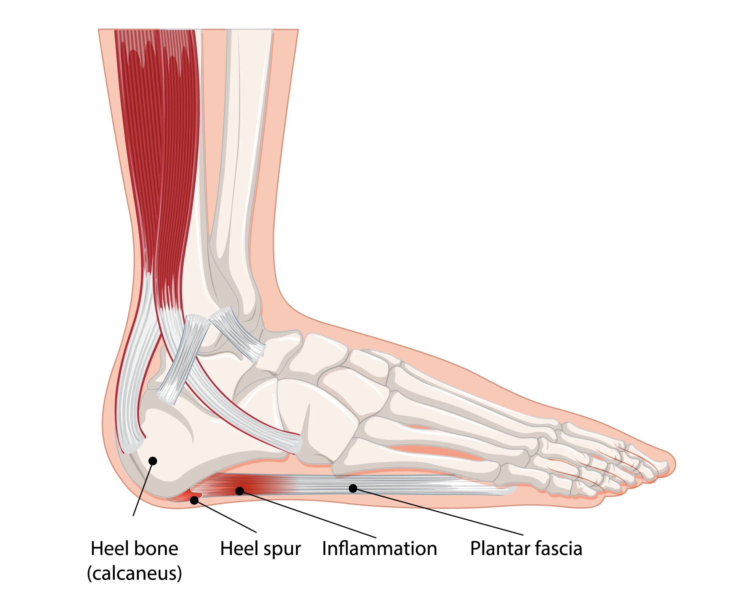 足底筋膜炎治療方法