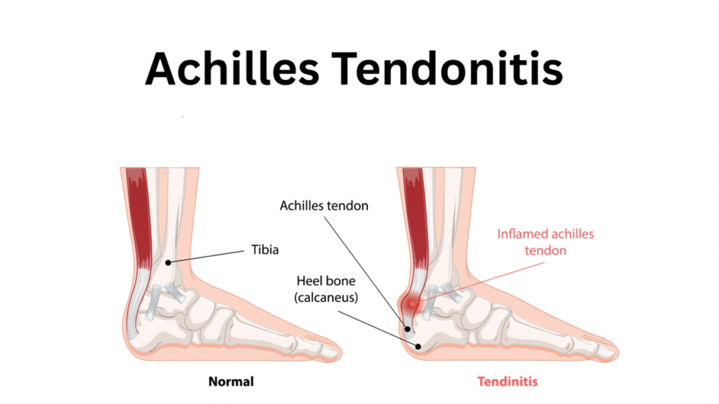 阿基里斯腱發炎多久會好