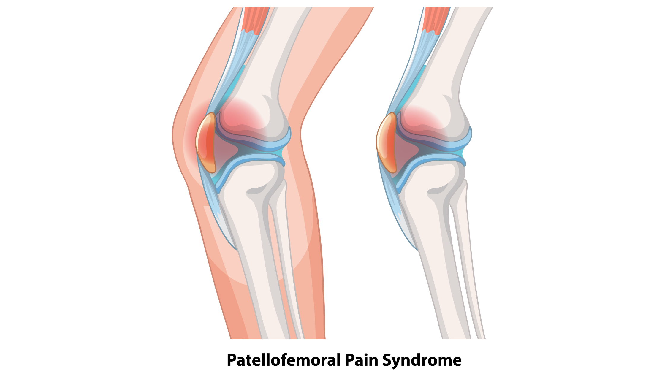 Patellofemoral Pain Syndrome