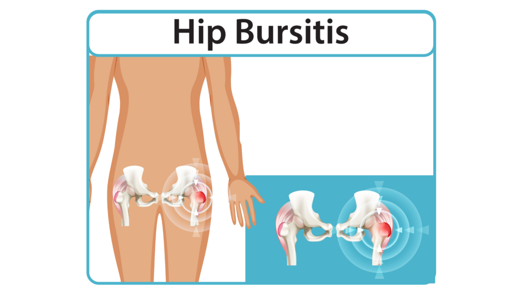 What is Hip Bursitis and Can Chiropractic Care Help