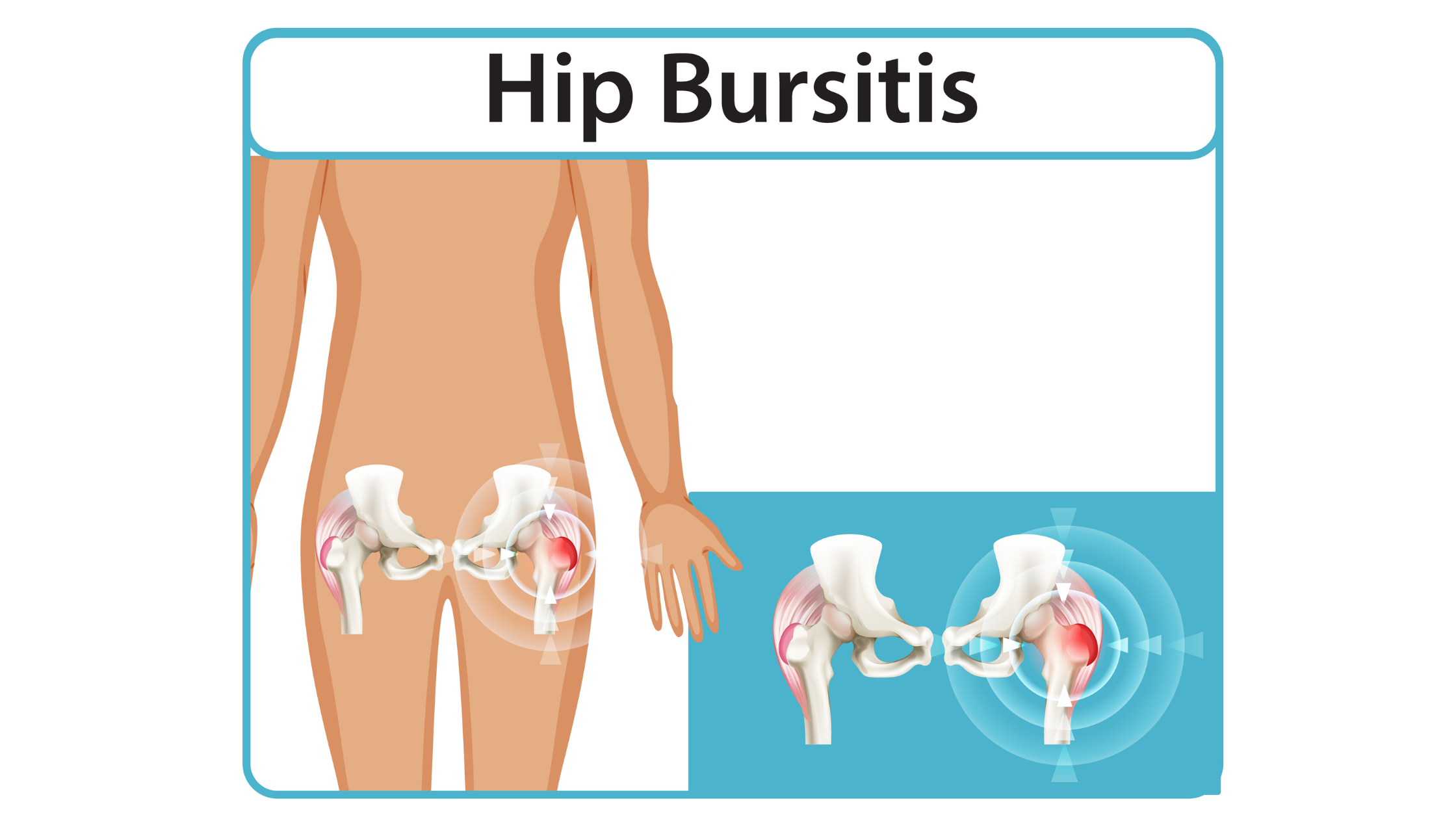 What is Hip Bursitis and Can Chiropractic Care Help
