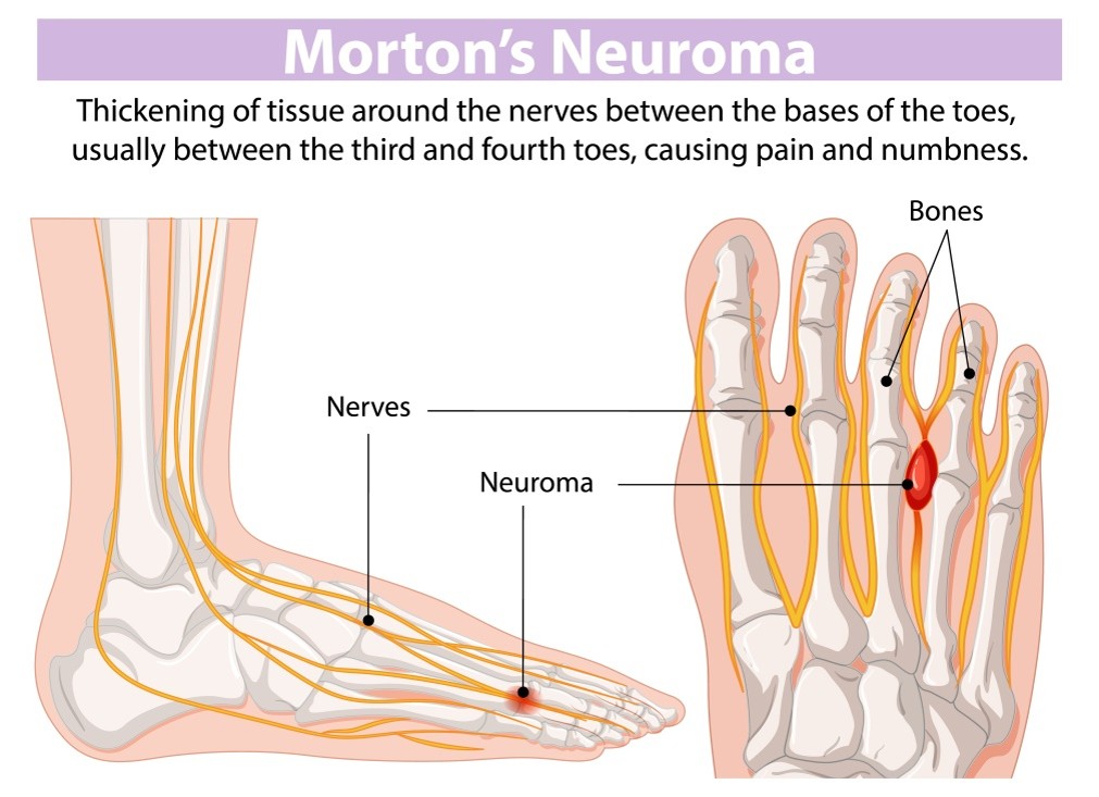 Morton Neuroma